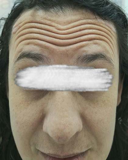 Antes do tratamento com toxina botulínica