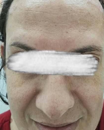 Depois do tratamento com toxina botulínica